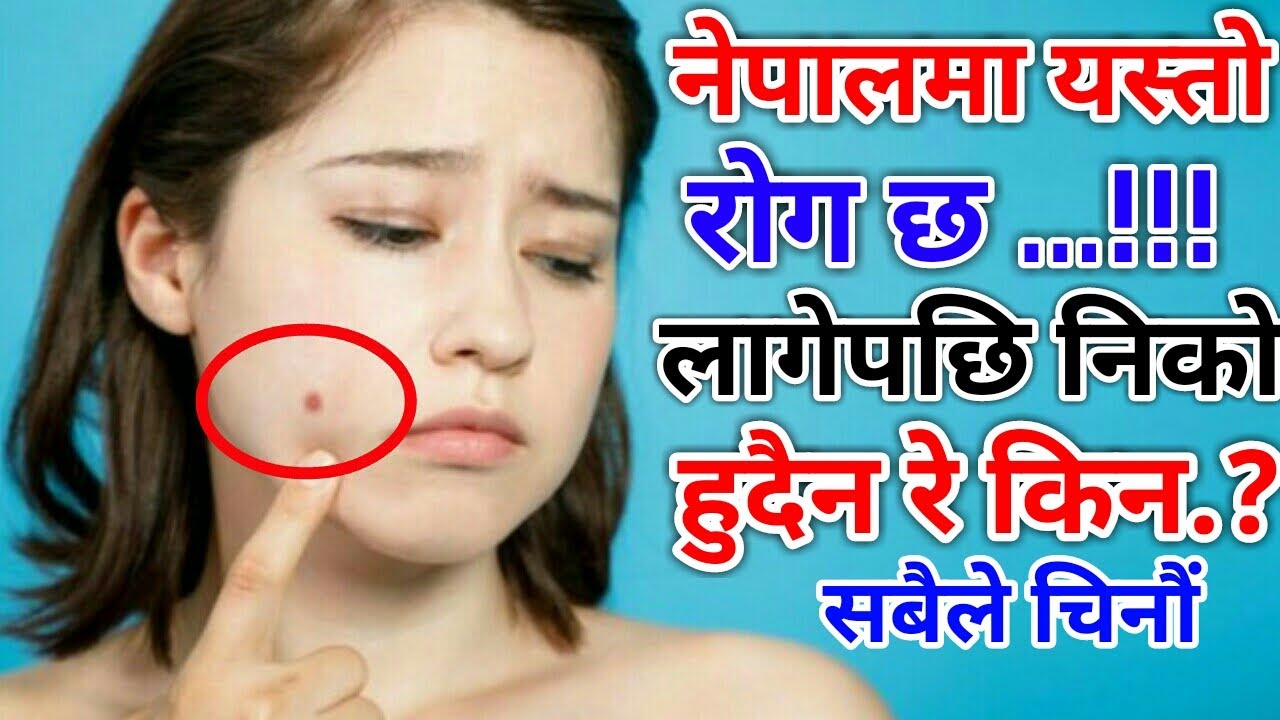 NEPALI HEALTH & EDUCATION TIPS नेपालमा यस्तो रोग छ लागेपछि निको हुन निकै..!