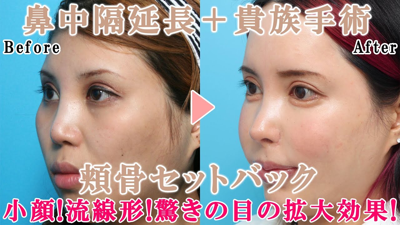 最強の複合手術！鼻中隔延長＋貴族手術＋頬骨セットバック｜ヴェリテクリニック