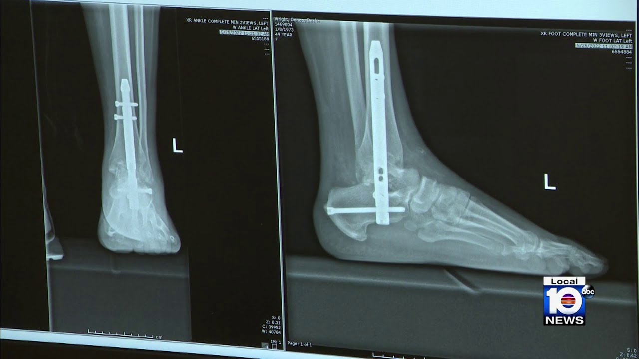 Mount Sinai medical specialist using less invasive approach to ankle fusion