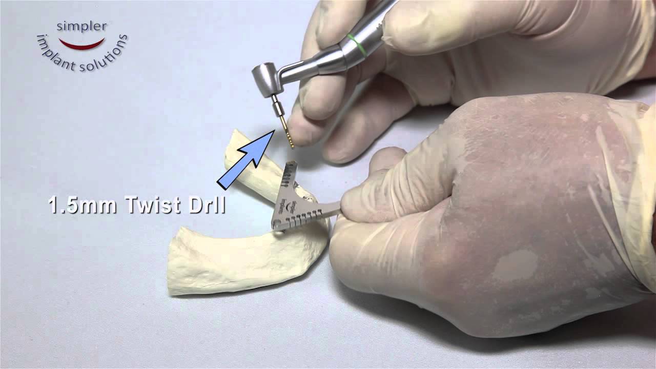 Parallel Implants Evertime with the Simpler Parallel Guide