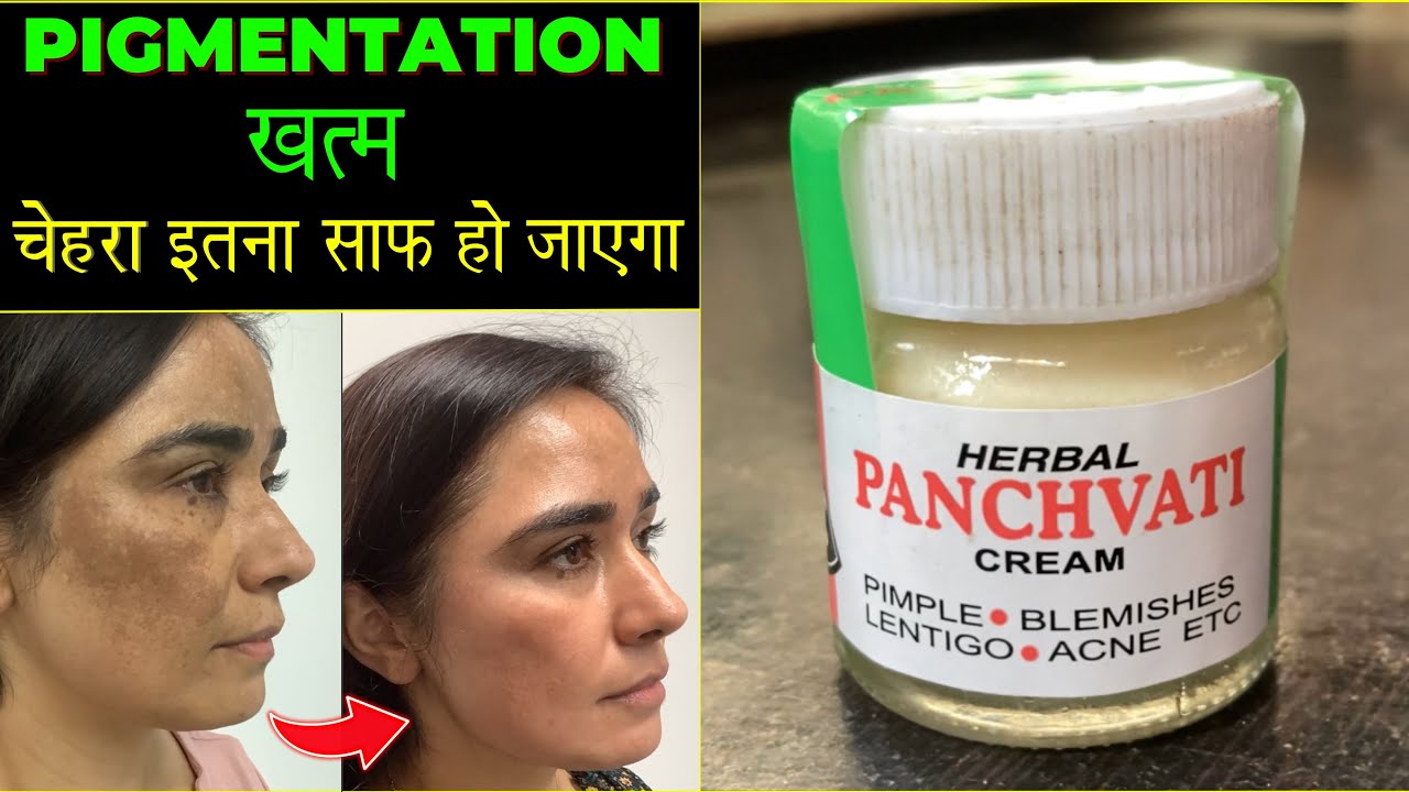 Panchvati cream | Uses, benefits, side effect | clean Pigmintation, Acne, pimple, lentigo from face