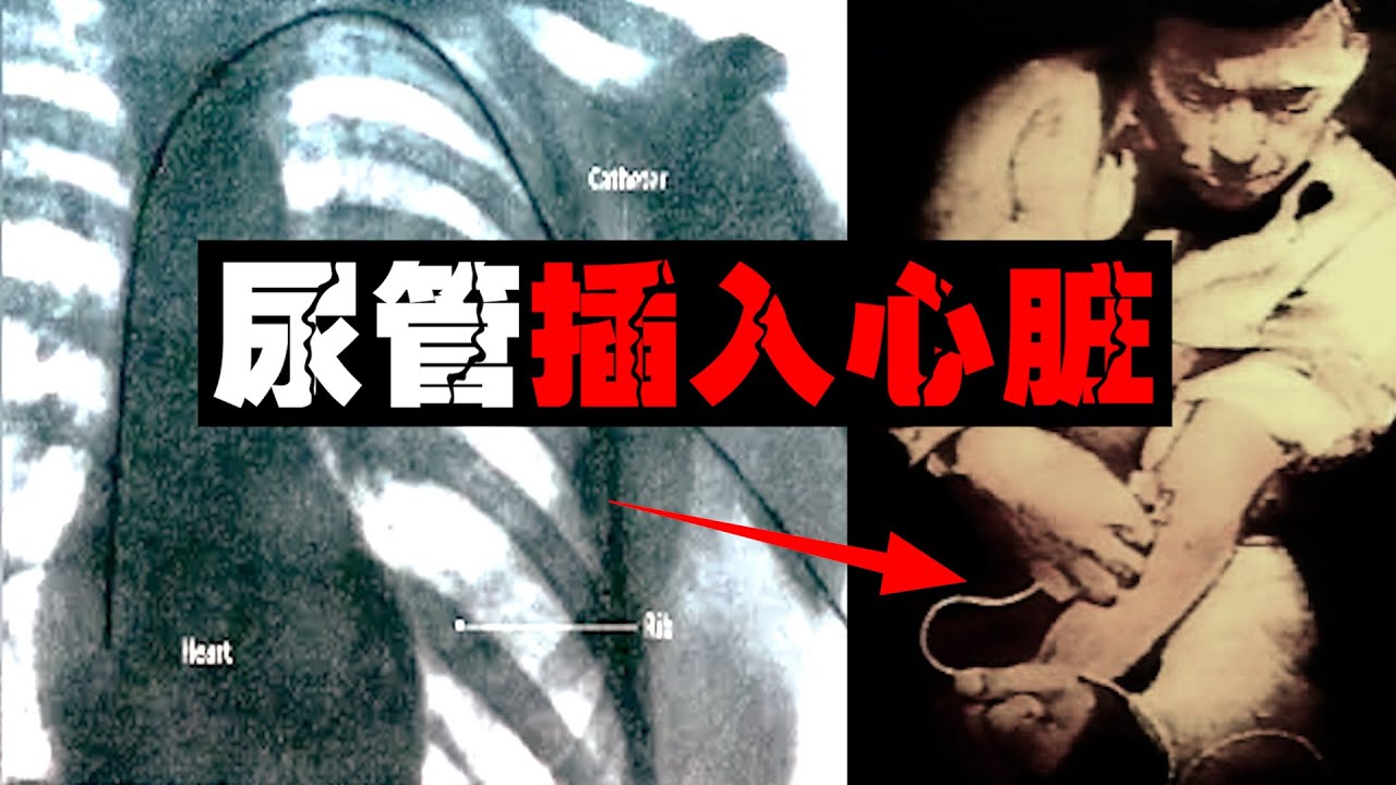 【癫狂诺贝尔】把尿管通过手臂插入心脏，这是他身体发生的变化。。