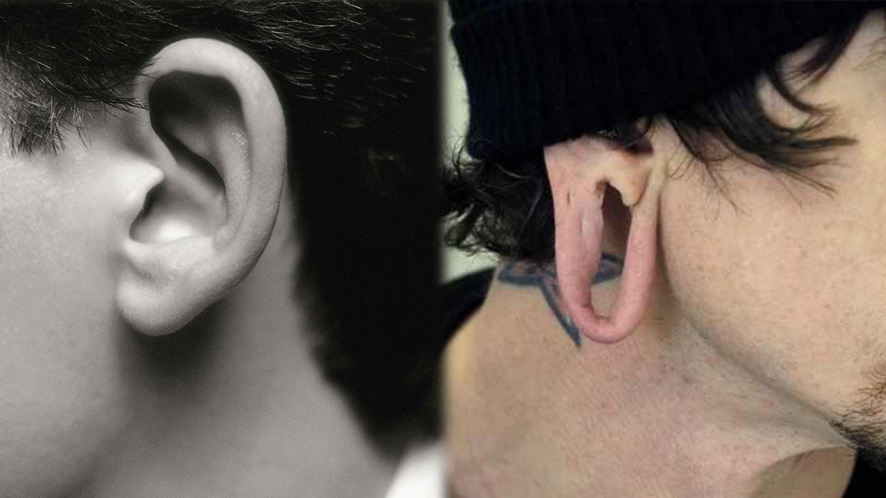 Hasta que tamaño puede llegar una dilatación y volver a la normalidad sin cirugía - Plugs