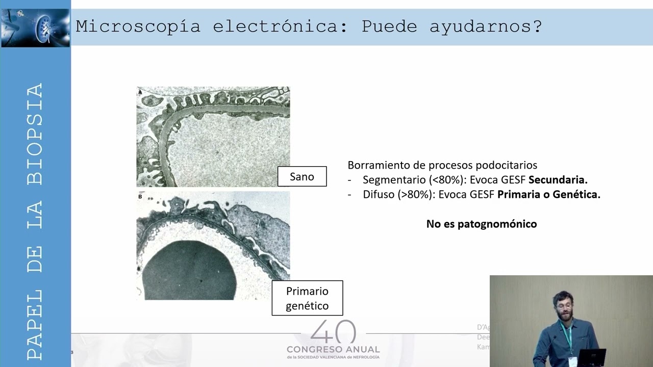 Avances en el Síndrome nefrótico primario.