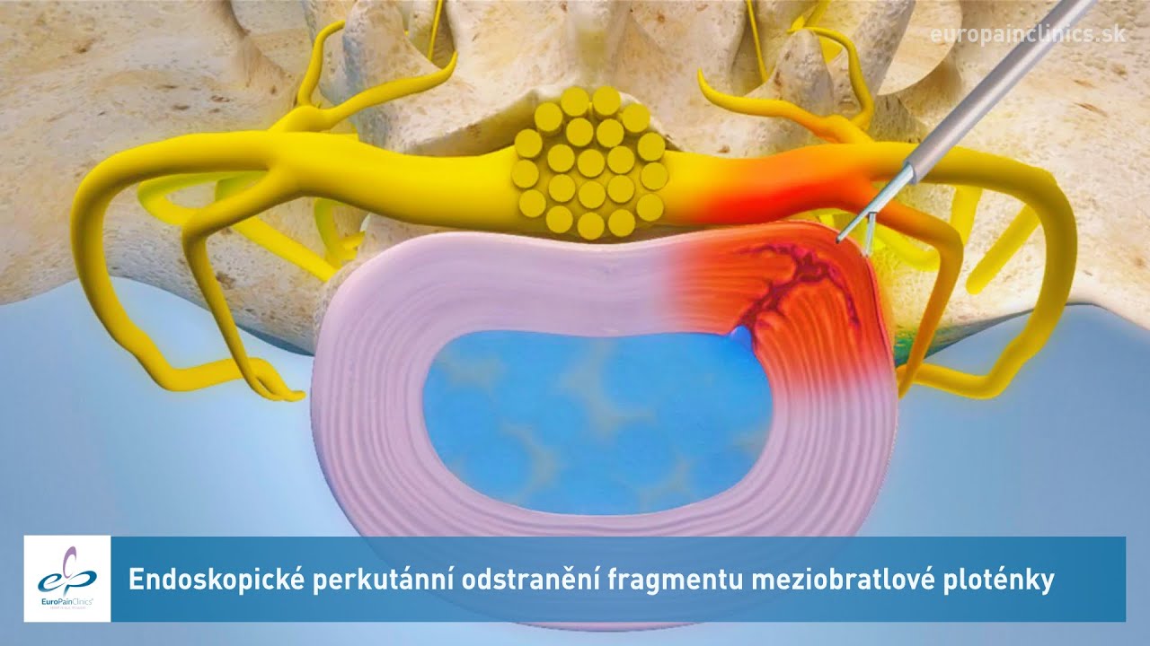 Endoskopické perkutánní odstranění fragmentu meziobratlové ploténky