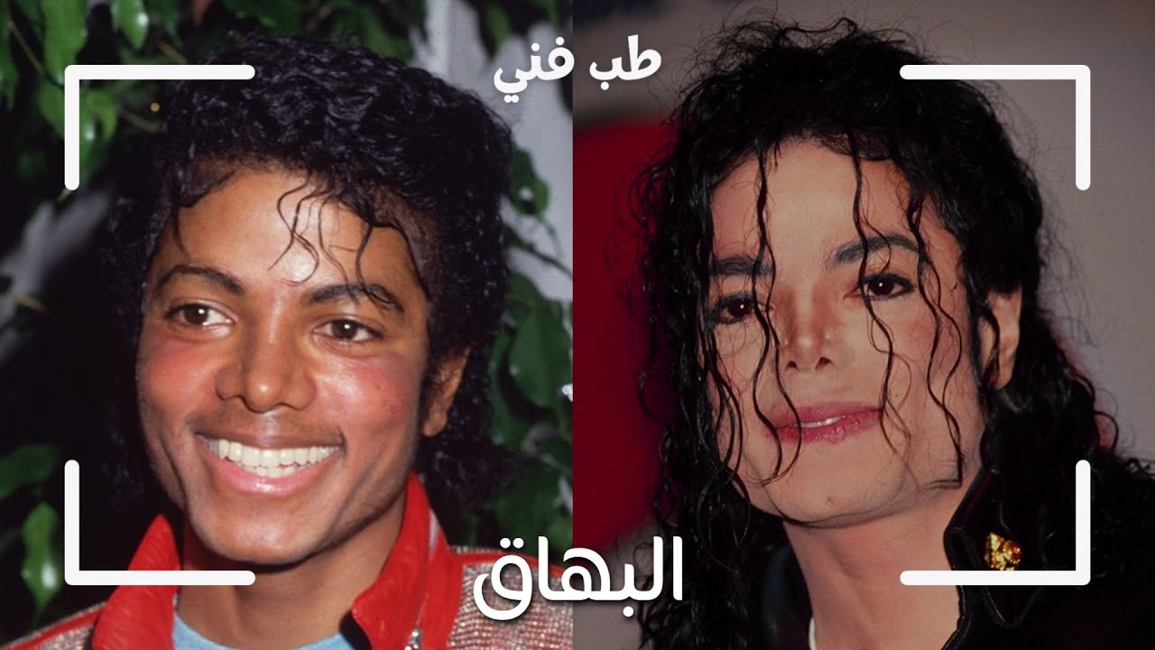 مايكل جاكسون - مرض البهاق | Michael Jackson - Vitiligo Disease
