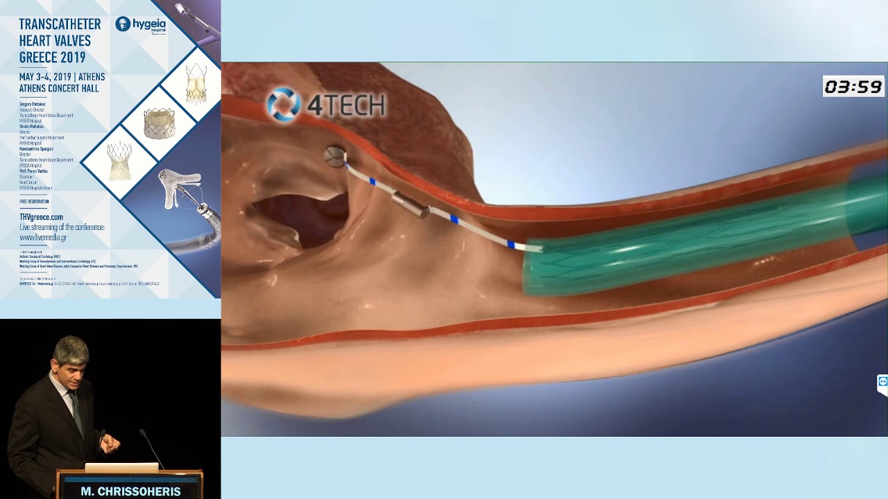 M. Chrissoheris | Advanced echocardiography assessment of the tricuspid valve.