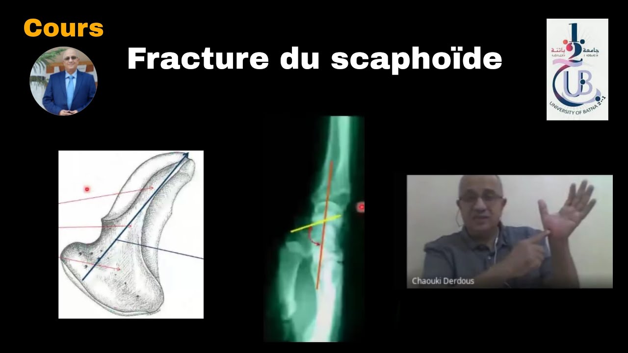 Les fractures du scaphoïde