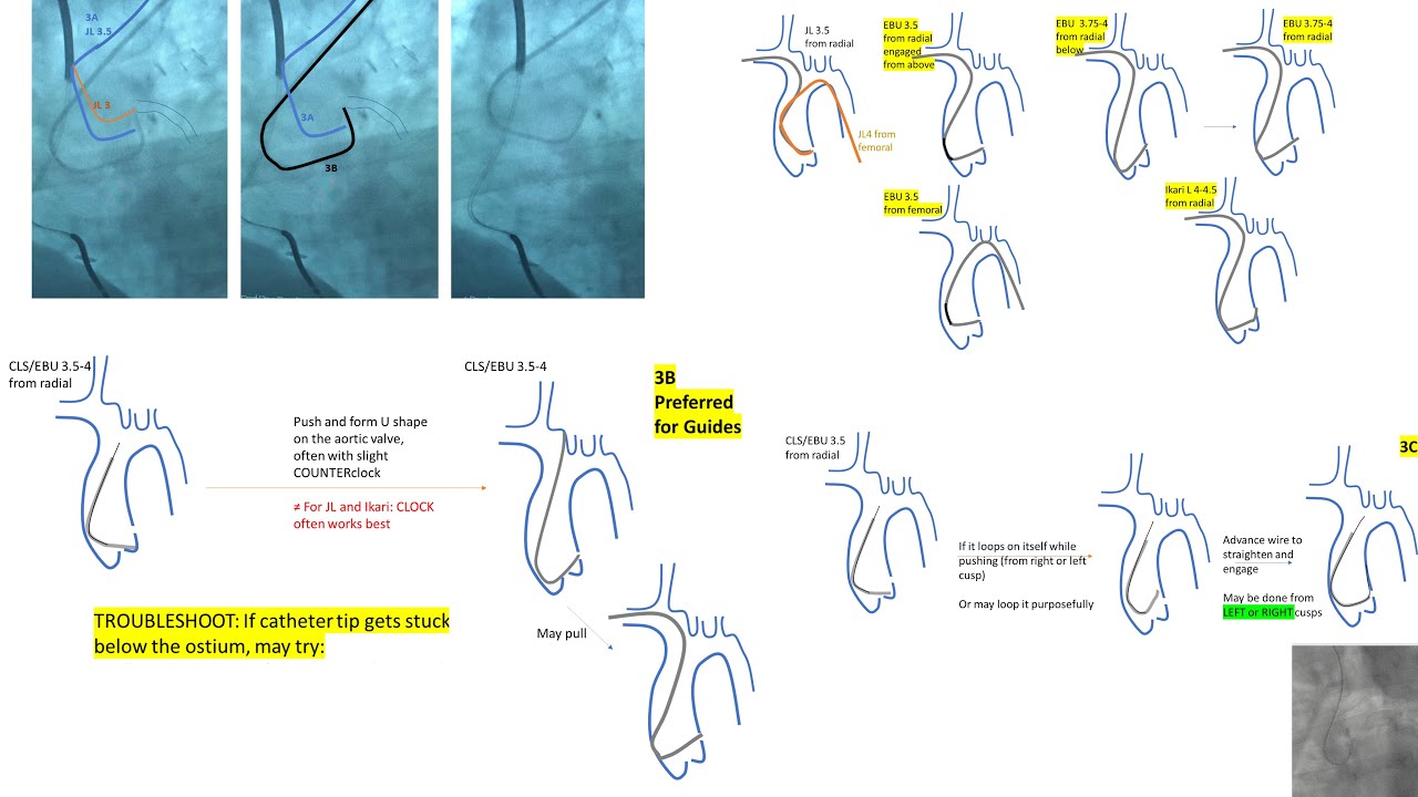 Left EBU/CLS guides manipulations, radial and femoral +Ikari L +Key tips in left coronary engagement
