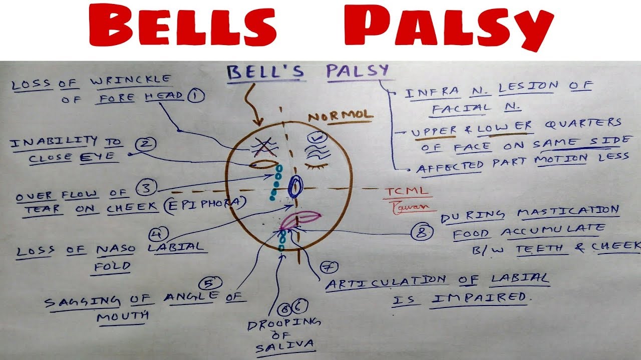 Bell's Palsy | Facial Paralysis | 7th Cranial Nerve | The Charsi of Medical Literature
