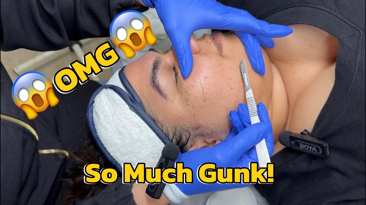Extreme Skin Scraping ASMR  Watch This Glow Up!