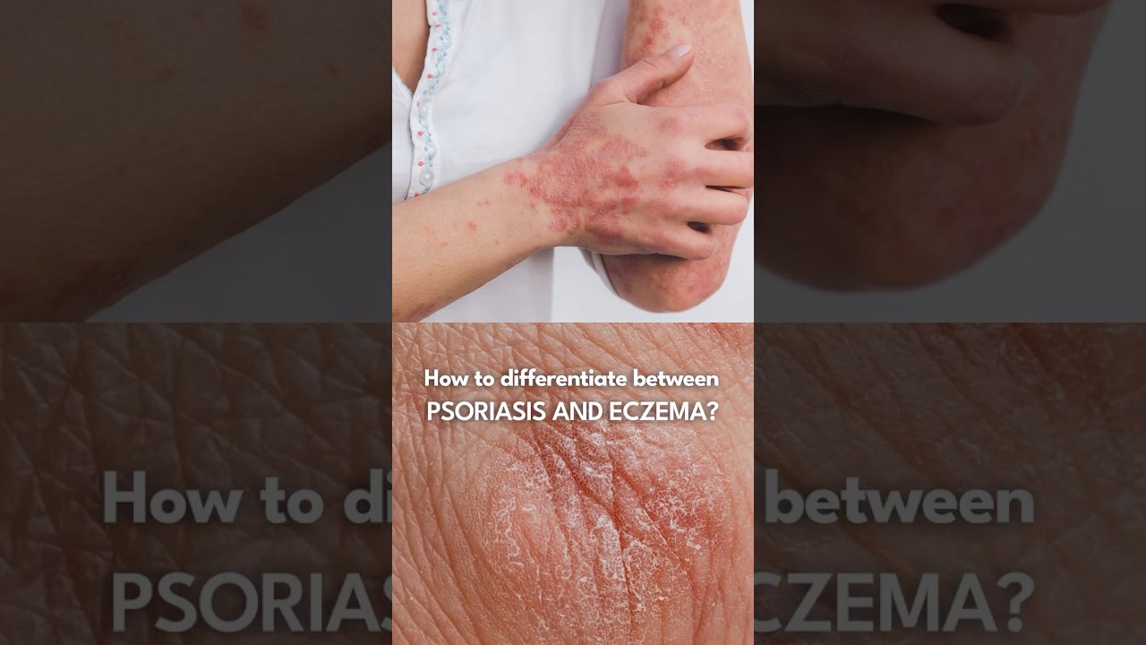 Psoriasis और Eczema में फर्क कैसे करें? | Difference Between Psoriasis & Eczema