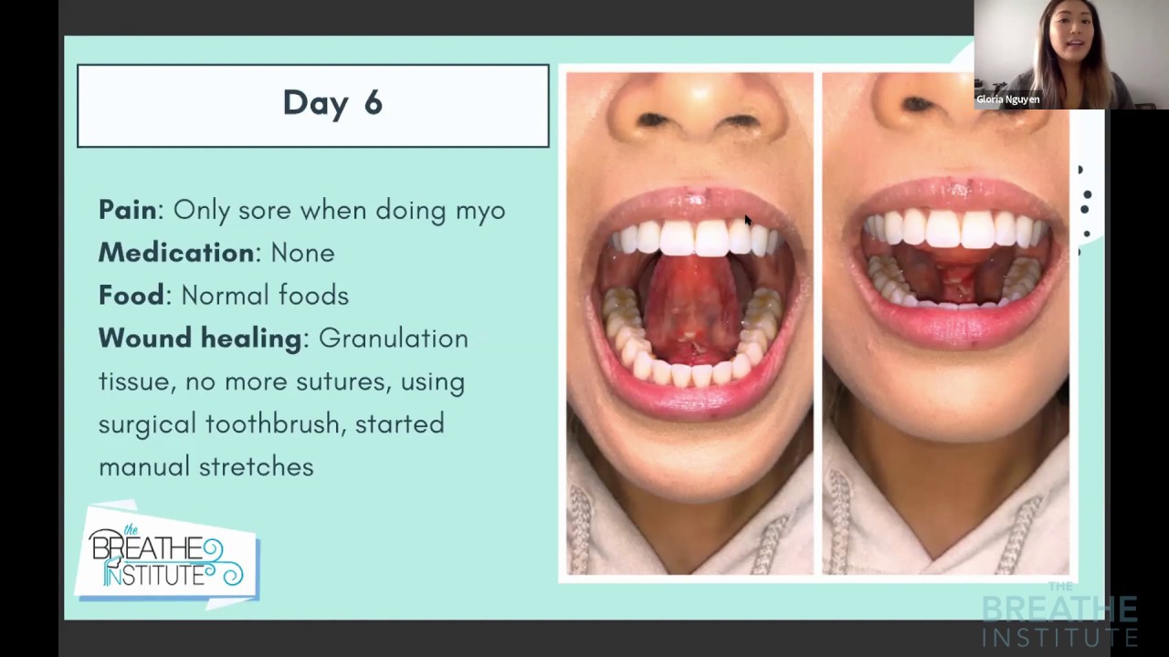 Gloria of The Breathe Institute shares her Tongue-tie journey-excerpt from The Breathe Course Online