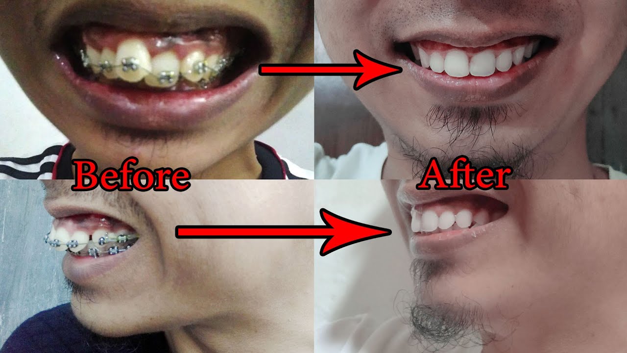 GOODBYE BRACES!!! My Braces Journey, 3 Years Time Lapse Transformation and Result, Before and After