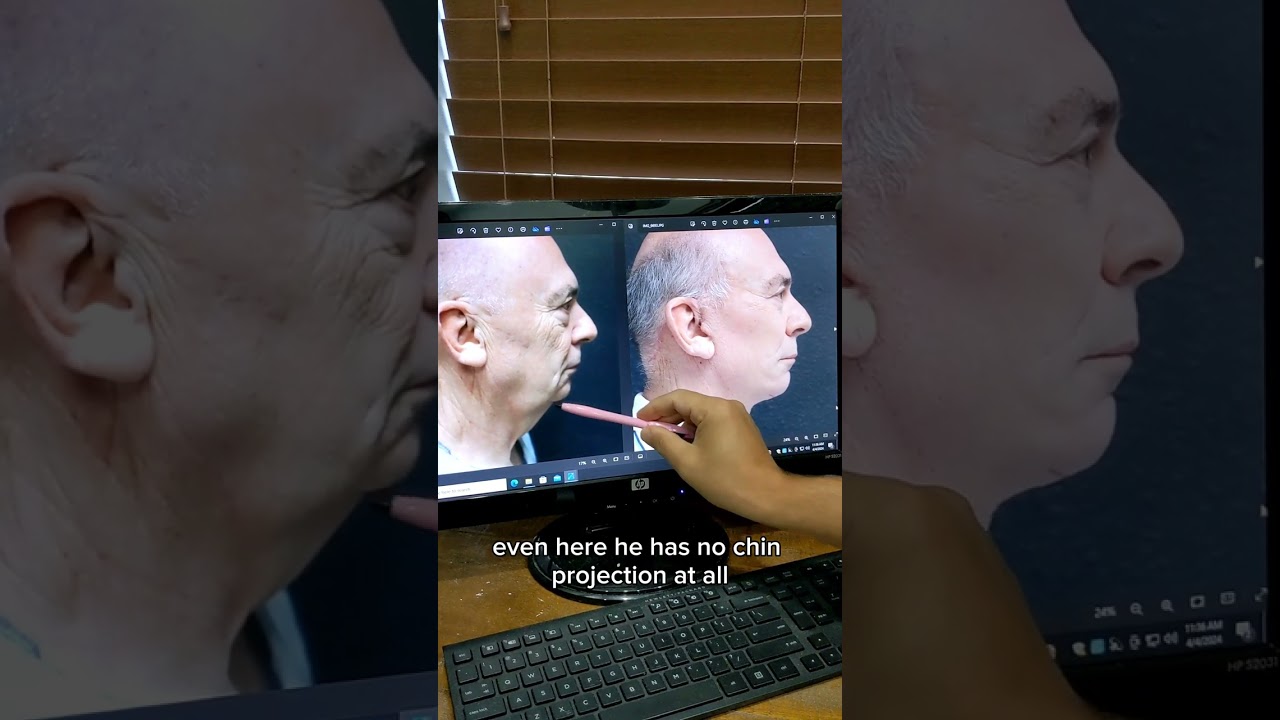 Deep Plane Facelift Expectations For Men