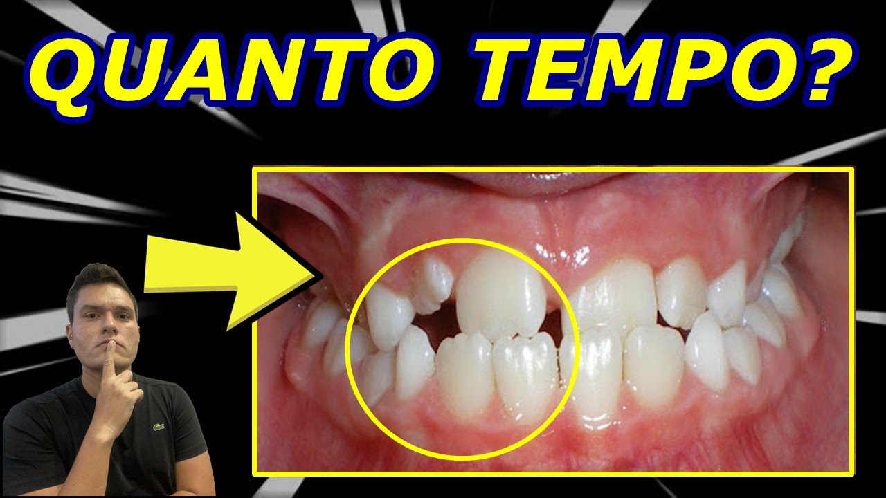 MORDIDA CRUZADA | QUANTO TEMPO PARA RESOLVER? | COMO É O TRATAMENTO?