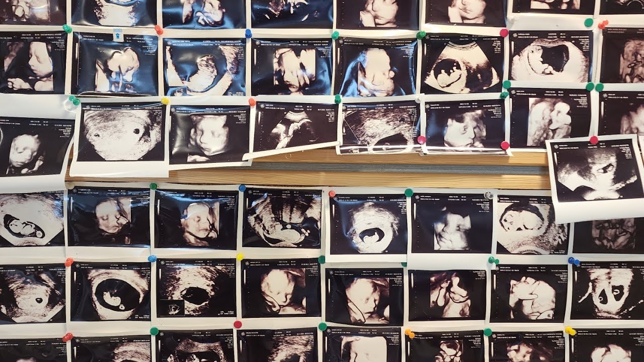 عمليات انابيت الاطفال🫃 افظل طريقه للحمل