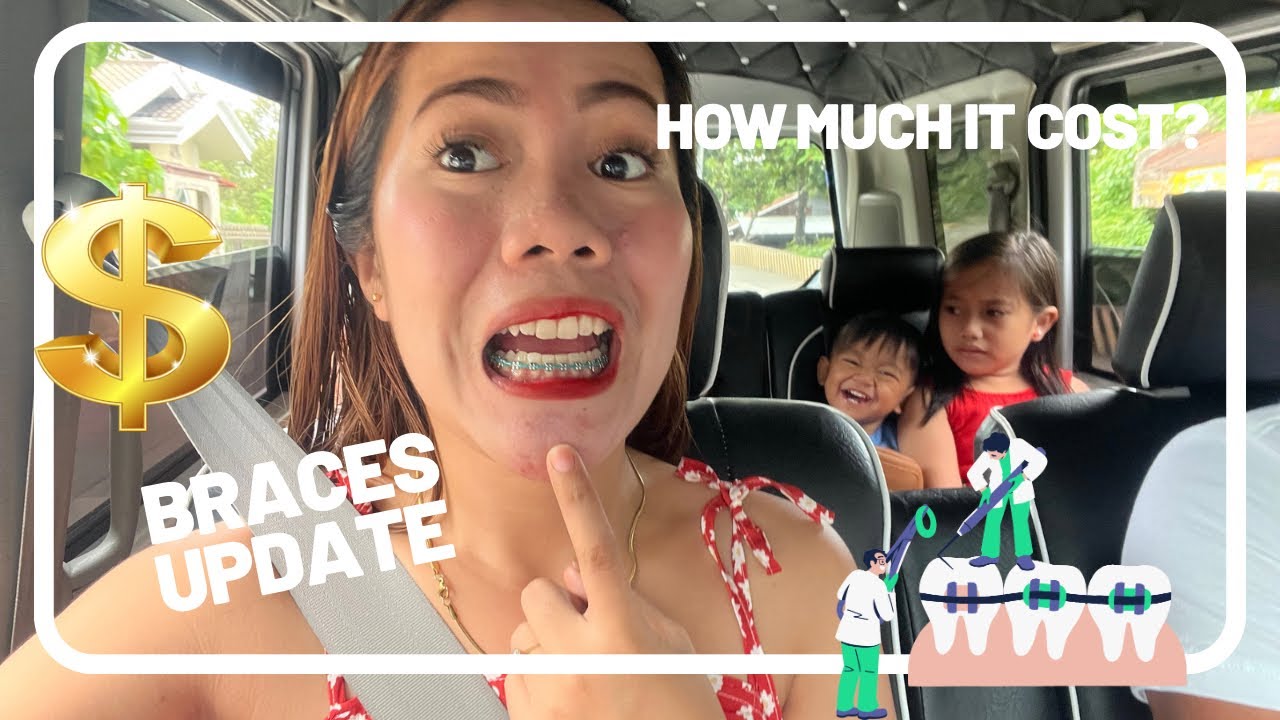 After 18 months Braces Update| Price for Braces