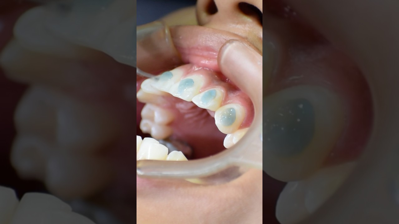 Colocaci&oacute;n de brackets