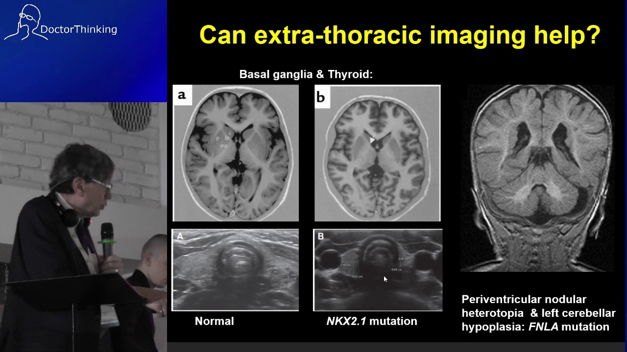 chILD: shifting paradigms in management of interstitial lung diseases in children - Andrew Bush