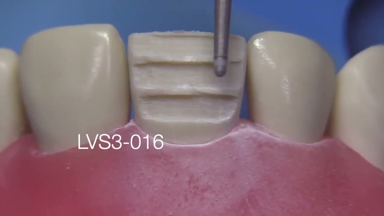 Porselen Lamina Veneer 3- İnsizal Butt Veneer Kesimi