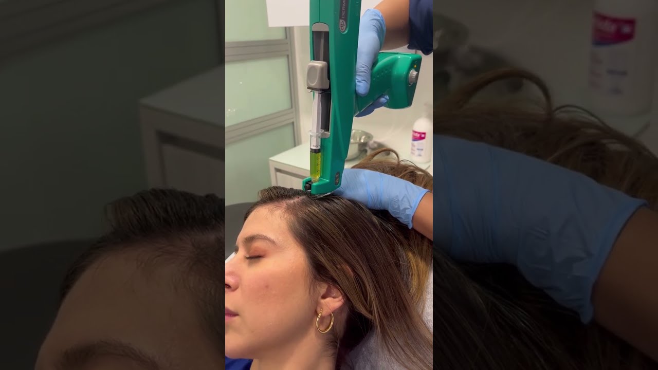 Plasma Capilar - Plasma Rico en Plaquetas - EsVital Center Salud & Bienestar