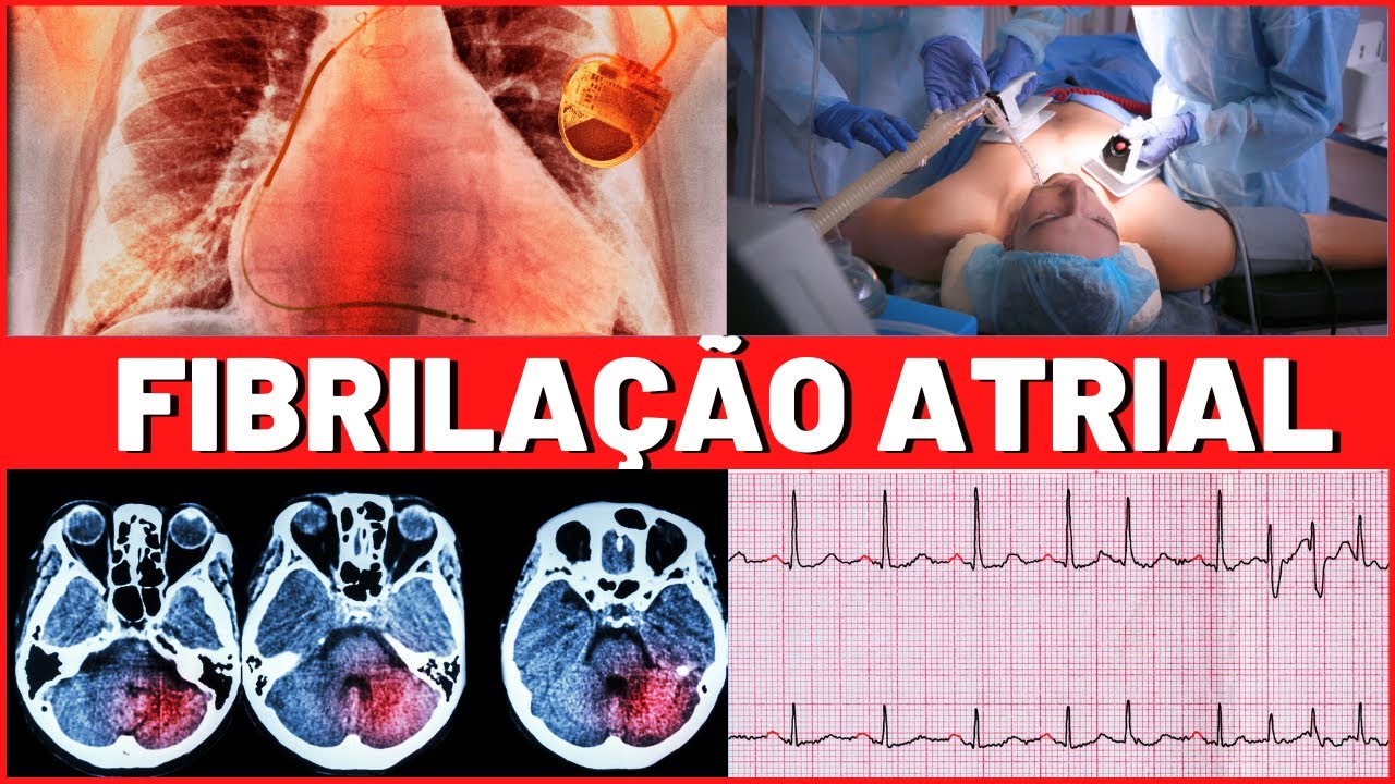 FIBRILAÇÃO ATRIAL  | O QUE É | CAUSAS | TRATAMENTO | É GRAVE | TUDO QUE VOCÊ PRECISA SABER