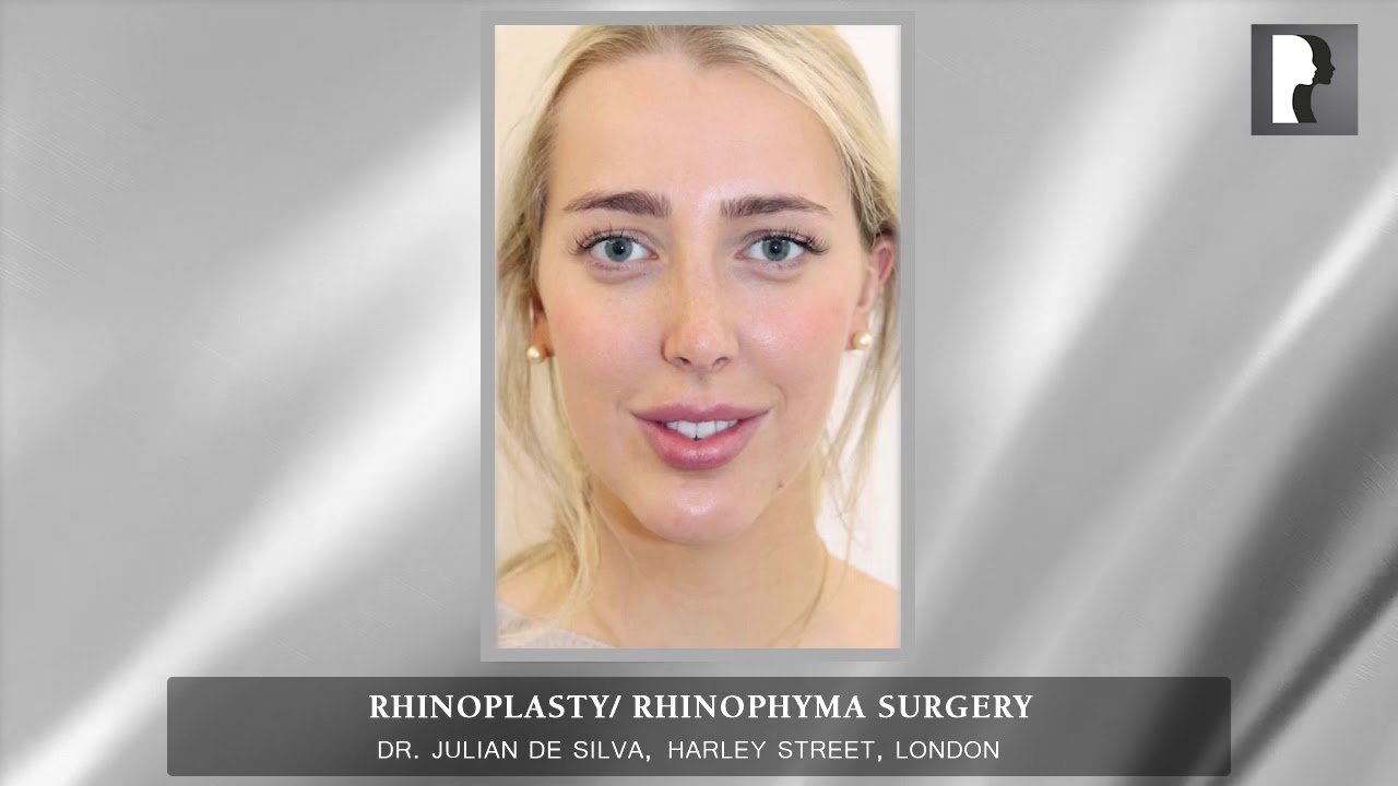 Rhinoplasty/ Rhinophyma Surgery Before-After
