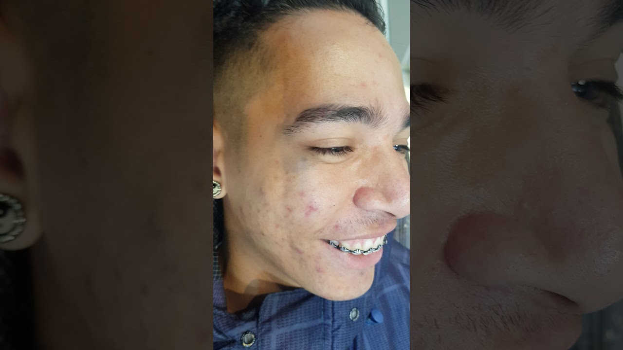 Fase final Remoção de Tatuagem no Rosto