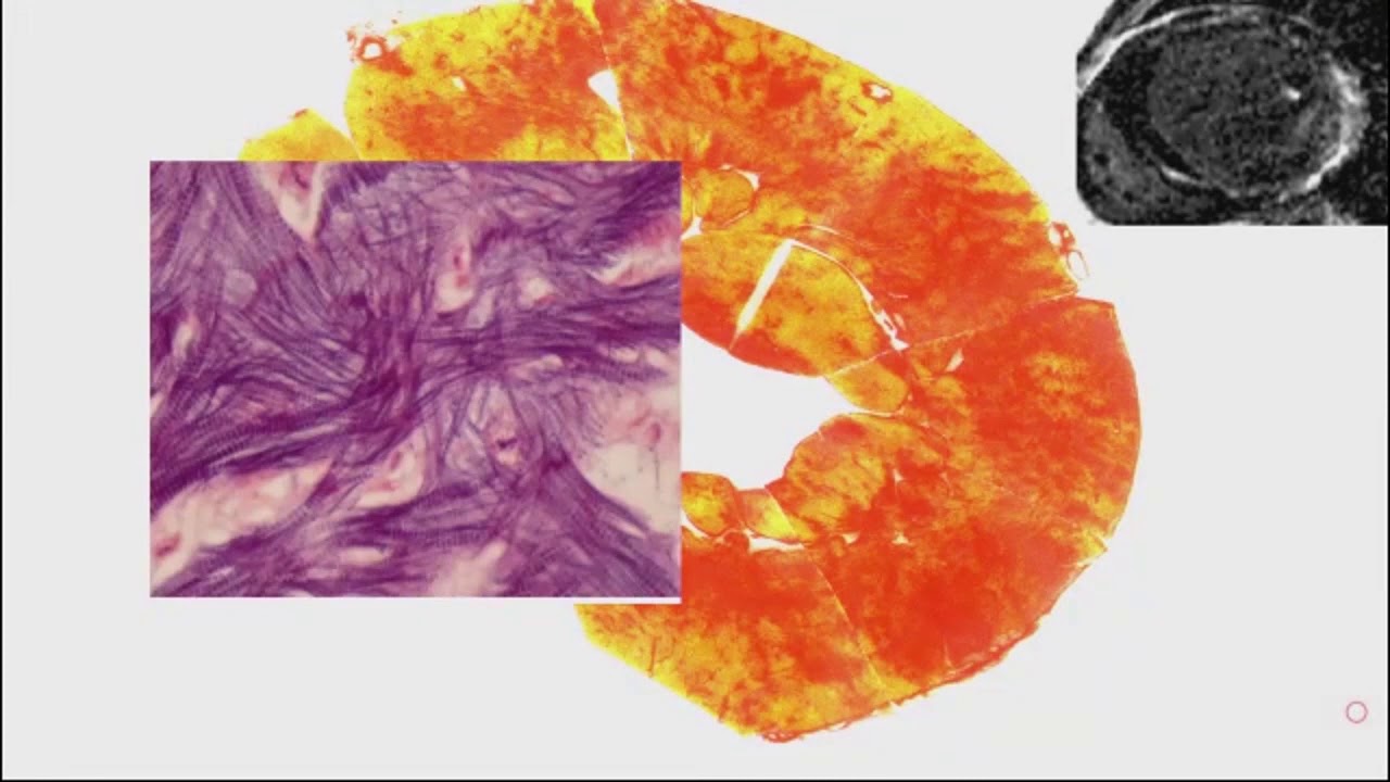 James C Moon, MD - Rethinking Myocardial Imaging: From Biology to Outcomes