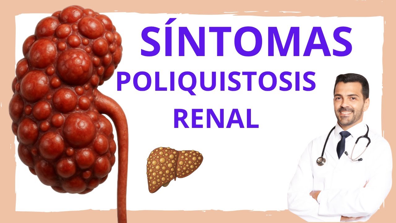 5 Síntomas de Poliquistosis Renal Autosómica Dominante: que DEBES CONOCER y 2 Extrarenales.