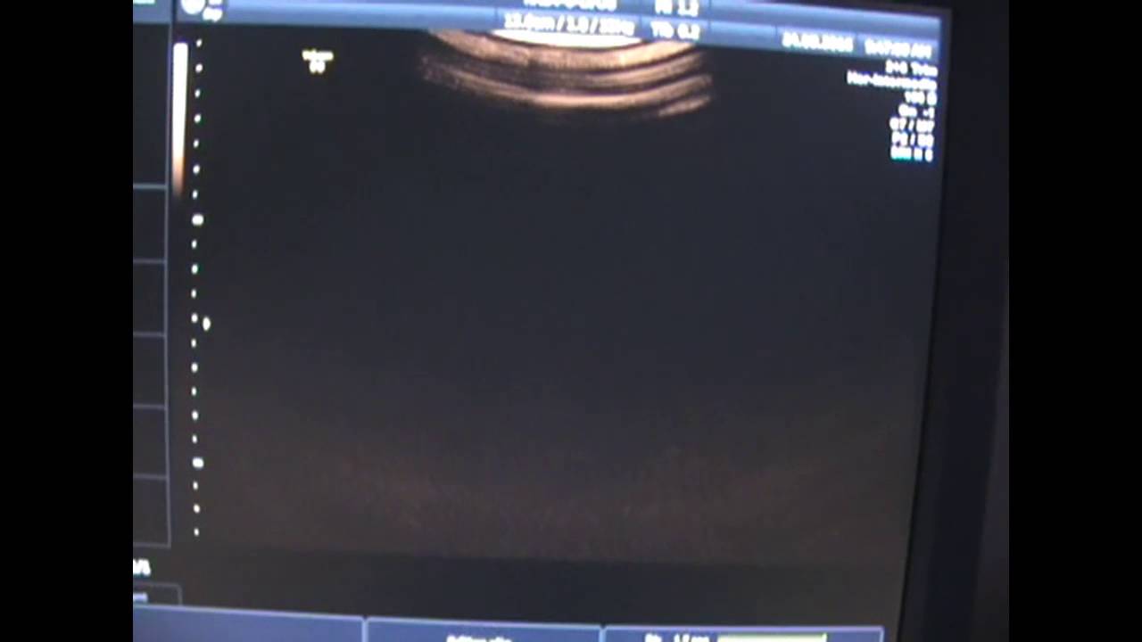 Creación de Presets en la Plataforma Voluson
