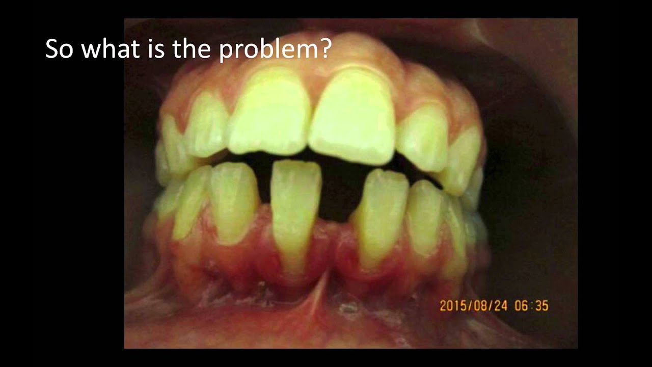 Recession on lower incisors. FGG or CT? (PART1)