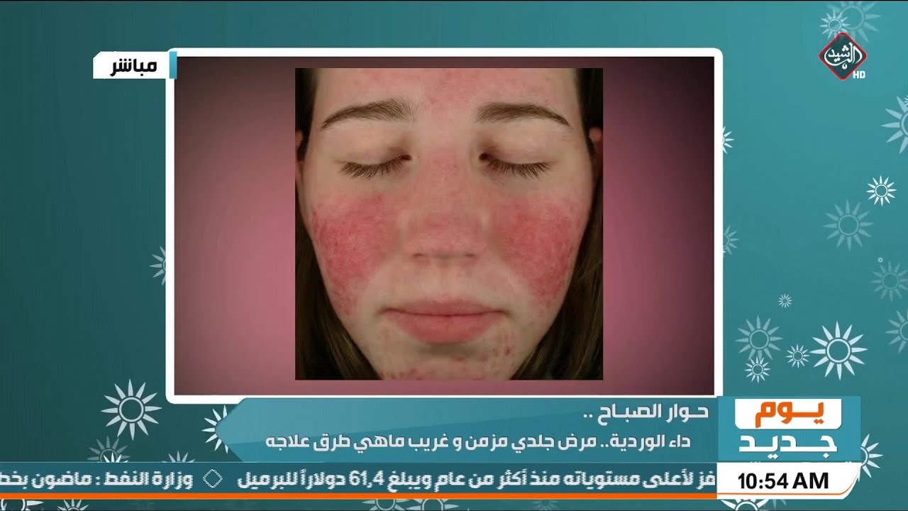 داء الوردية.. مرض جلدي مزمن وغريب, ماهي طرق علاجه | اخصائي الجلدية الدكتور علي السندي