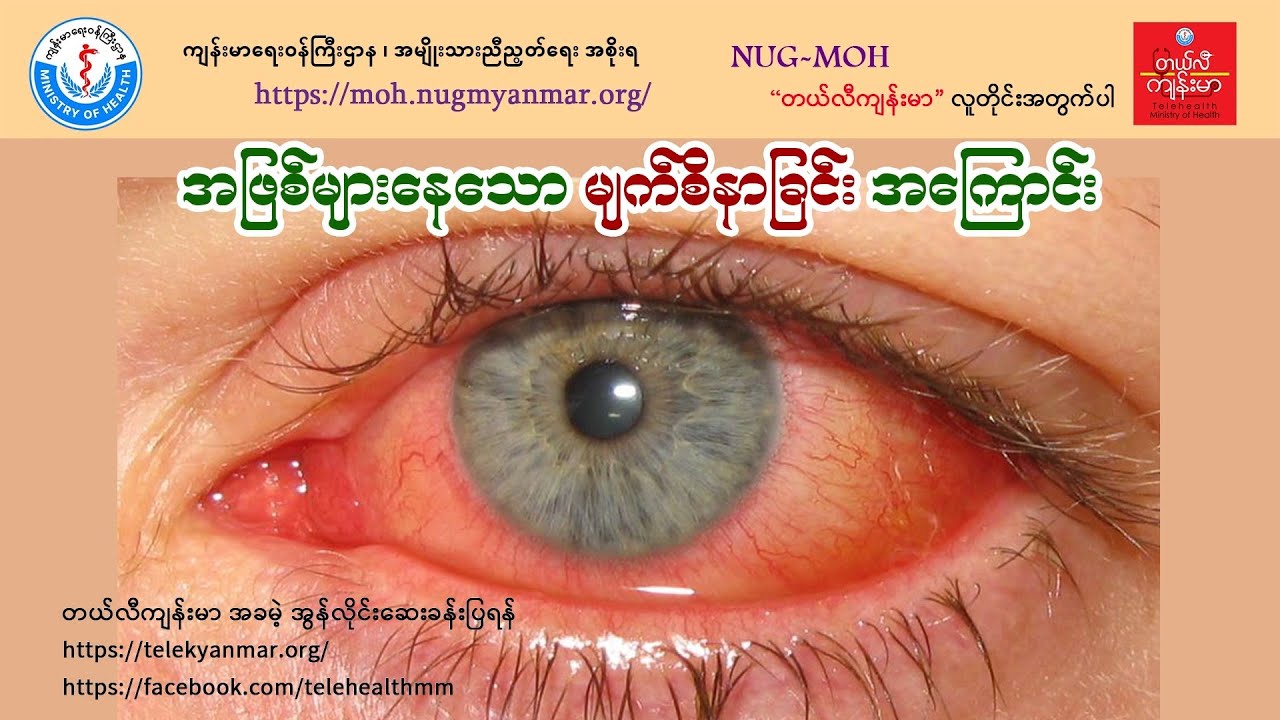 အဖြစ်များနေတဲ့ မျက်စိနာခြင်းအကြောင်း