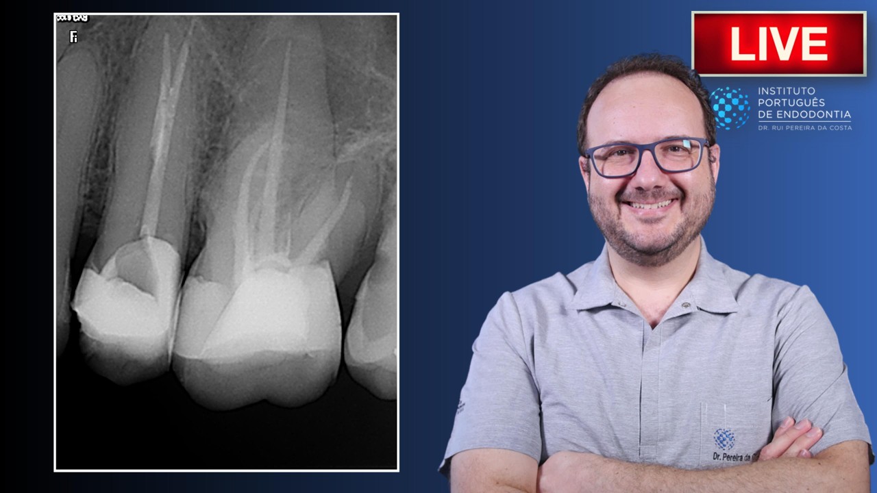 🦷25 with Big Carious Lesion | IP ▶️ Single Session | CASE338