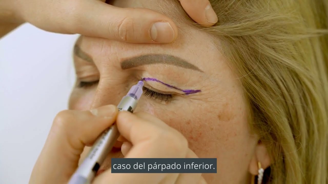 En qué consiste la Blefaroplastia, por el Dr. Humberto Rodríguez Menés