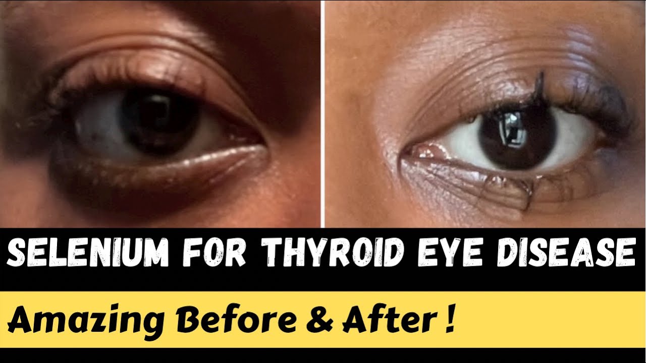 My Experience with Selenium for Thyroid Eye Disease