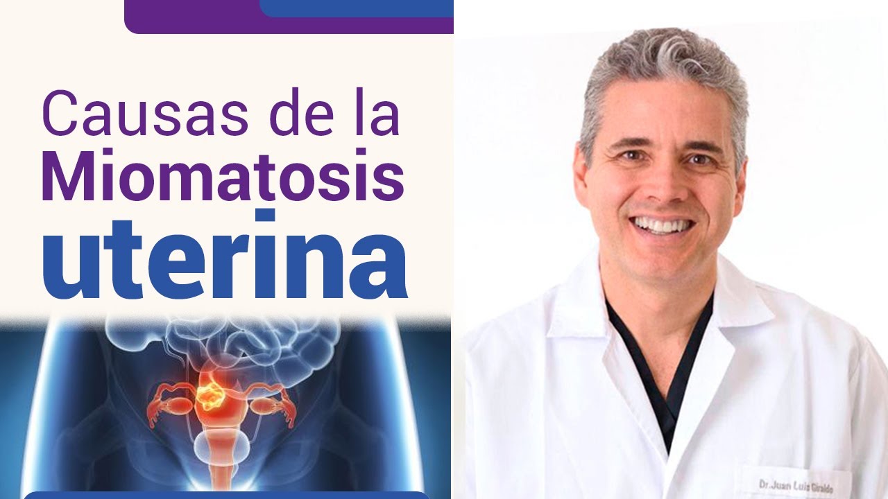 ¿Por qué salen los miomas? Causas explicada - Dr. Juan Luis Giraldo