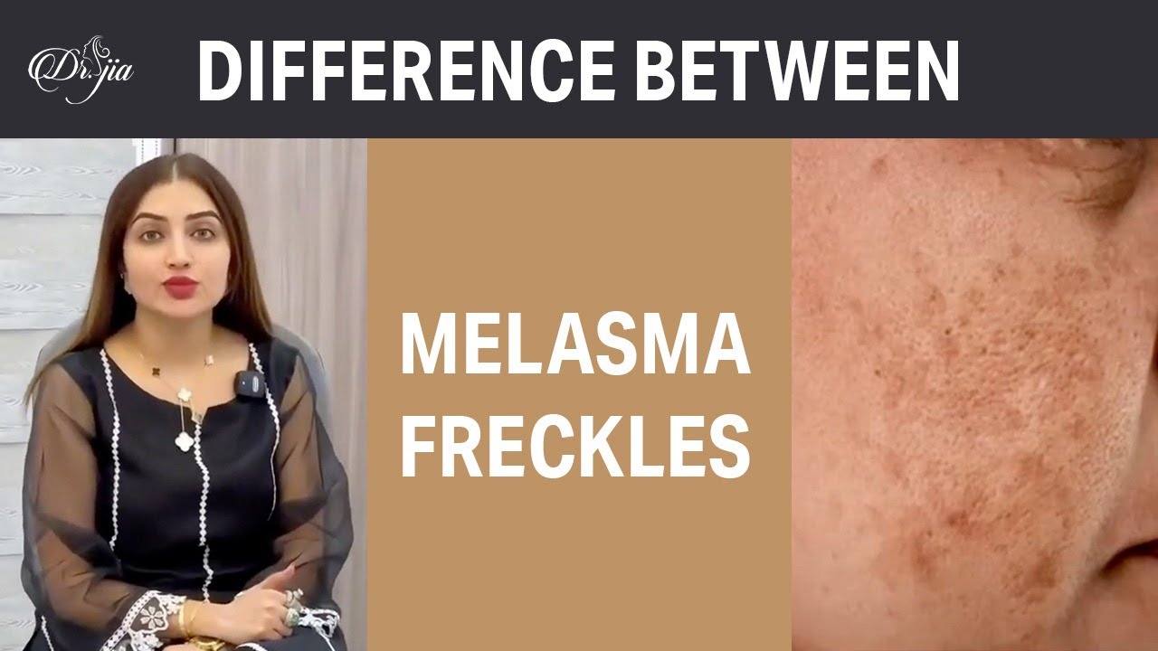Difference Between Melasma and Freckles || Best Dermatologist in Dubai UAE || Skin Specialist in UAE