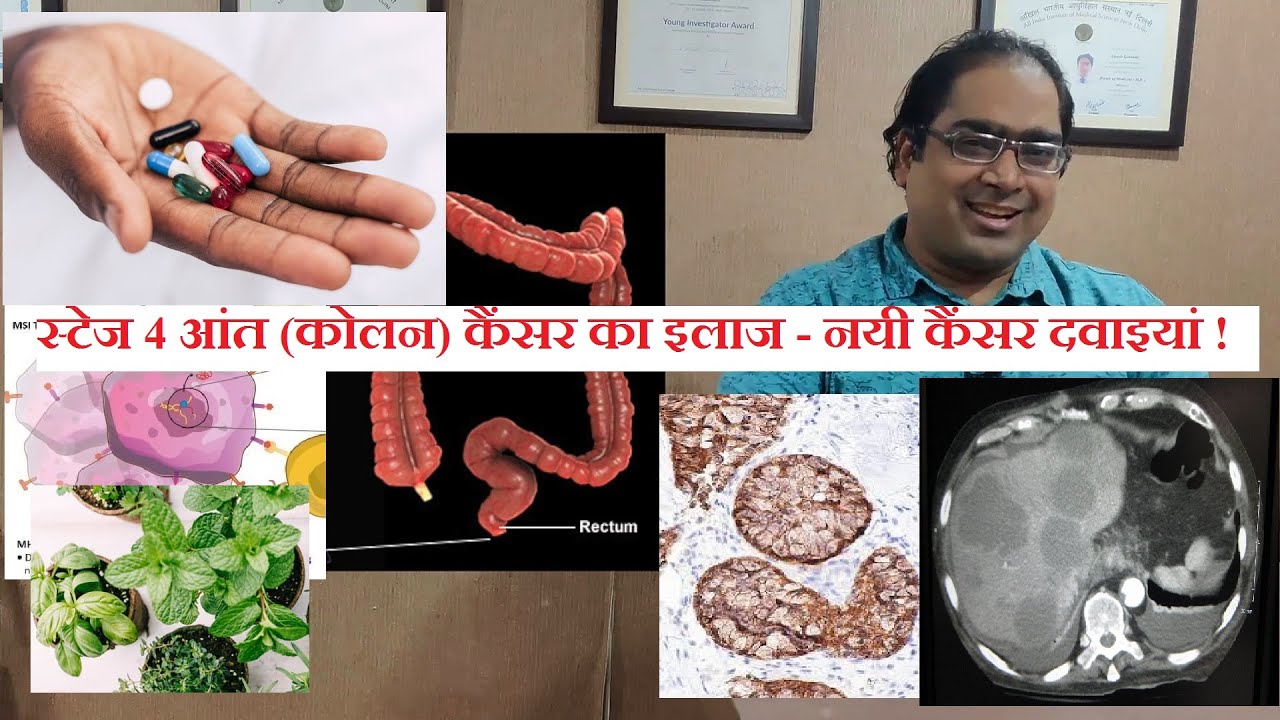 स्टेज 4 आंत (कोलन, रेक्टम) कैंसर इलाज - DM(AIIMS) - Stage 4 colon rectum cancer treatment 2020