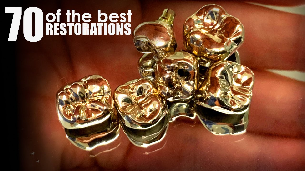 70 of the Best Posterior Restorations