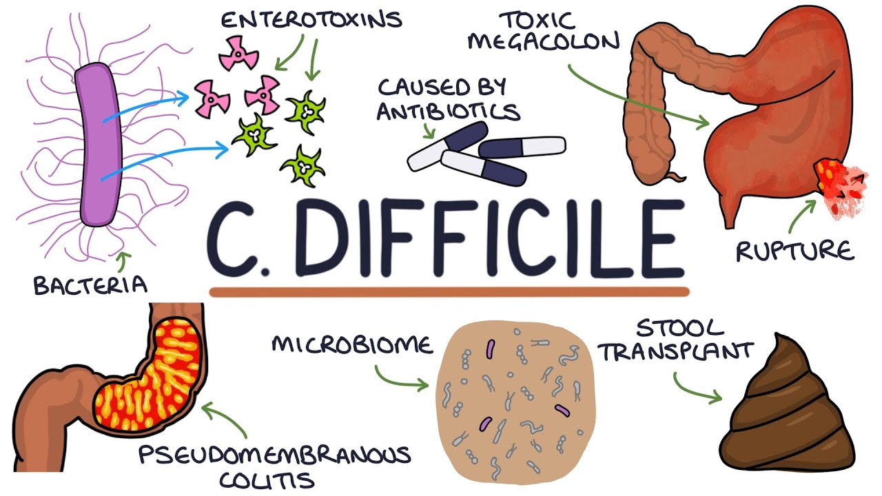 Понимание инфекции Clostridium Difficile (C. Diff)