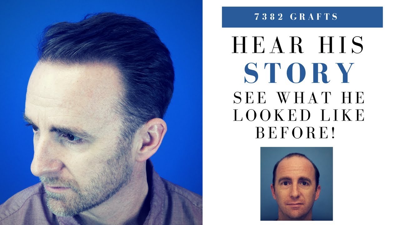 Hair Transplant | 7382 Grafts Hairline, Frontal Zone & Mid Scalp