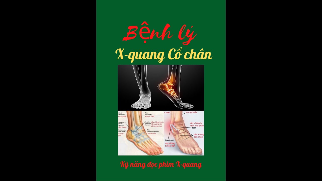 Bệnh lý X-Quang Cổ chân