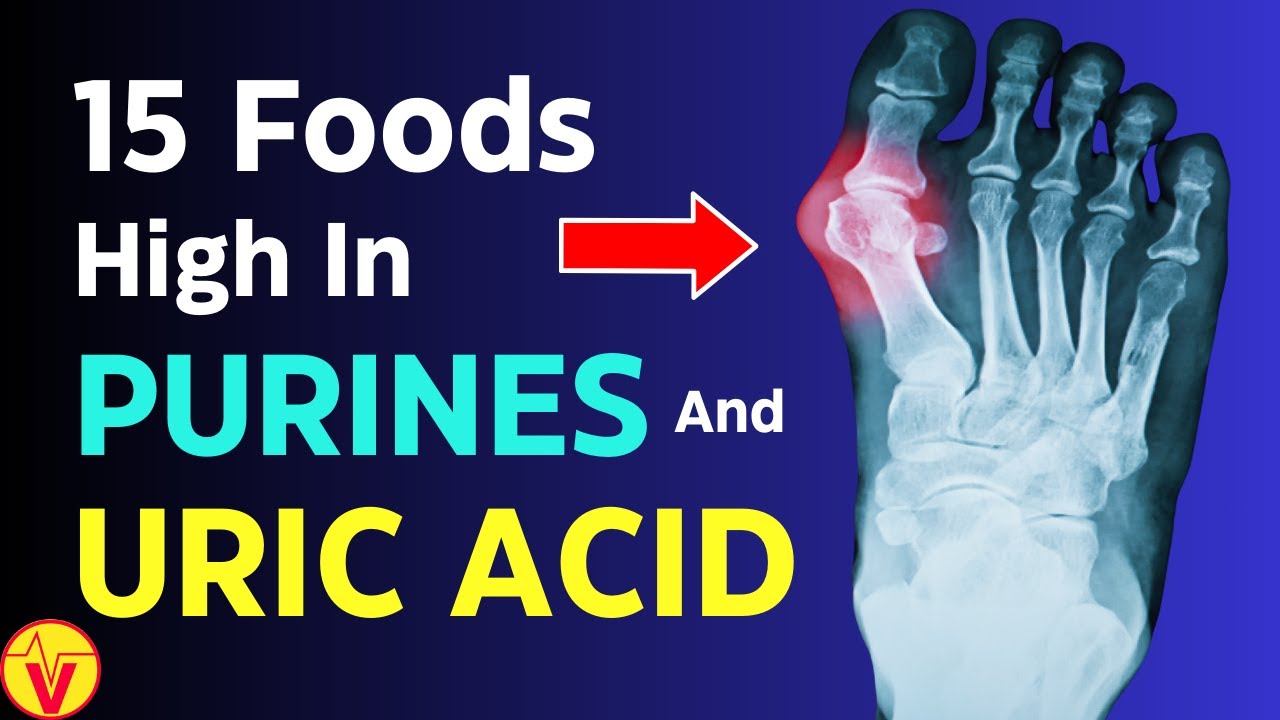 15 Foods HIGH in Purines and Uric Acid | Uric Acid Foods to Avoid | VisitJoy