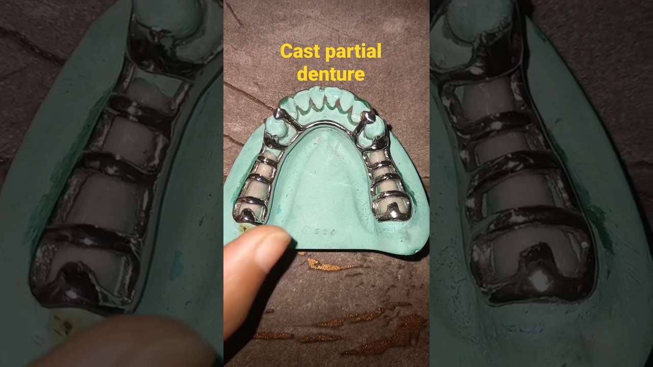 CAST PARTIAL DENTURE  #denture  #bds #cpd #MDS #dentistry #dental #teeth #tooth #prosthodontics #BDS