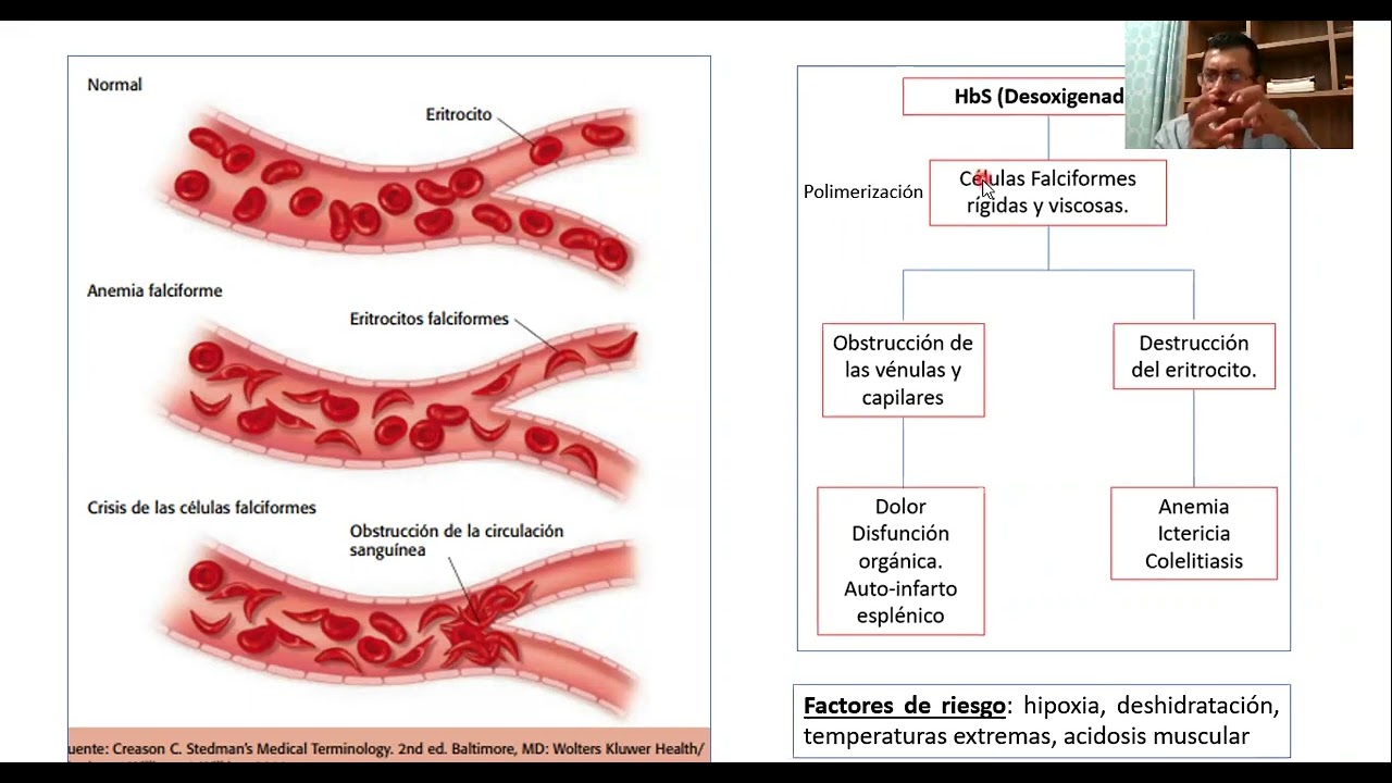 ANEMIA DE CÉLULAS FALCIFORME. Parte 1
