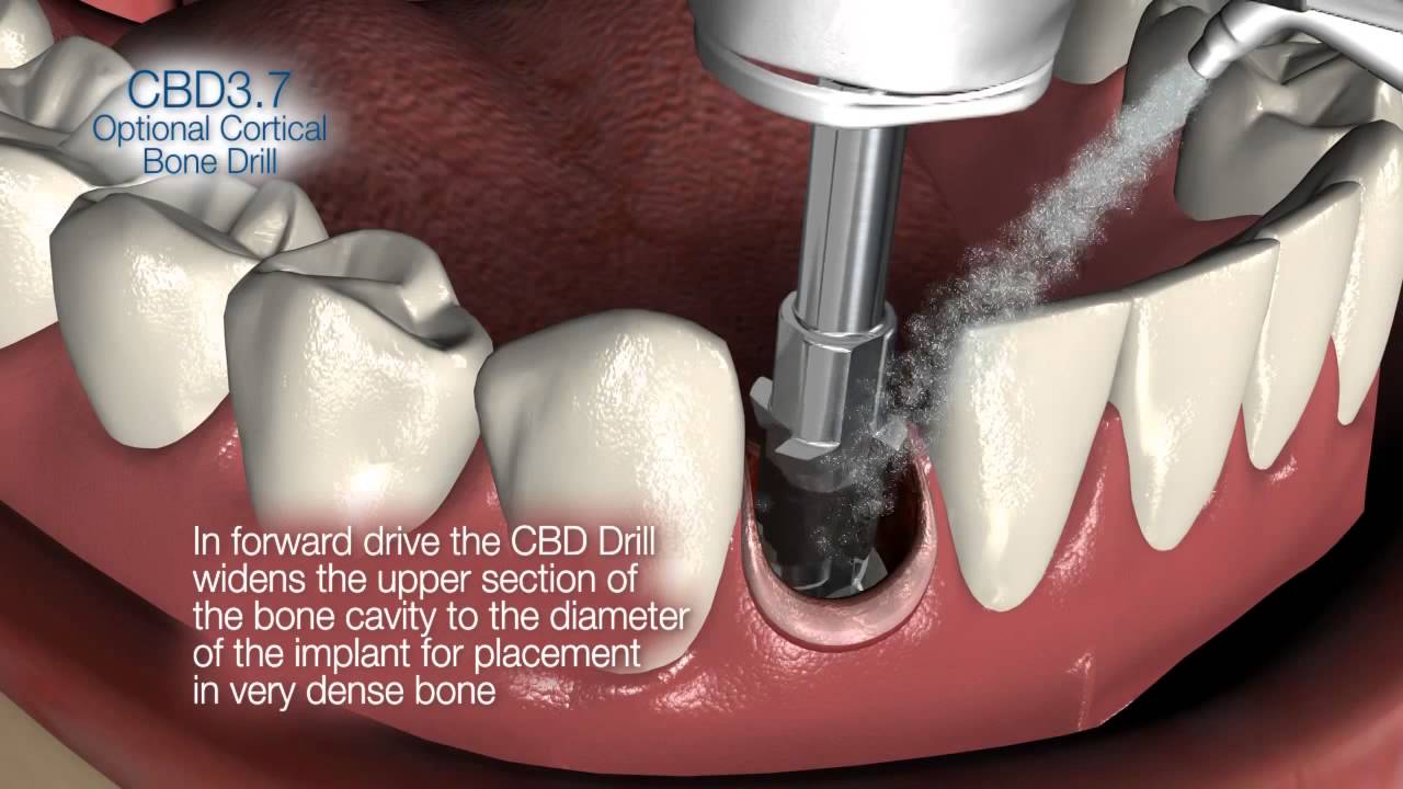 Implant Direct