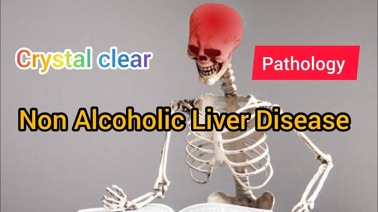 Non Alcoholic Fatty Liver Disease | Pathology| MAT Medicos